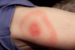 lyme disease rash